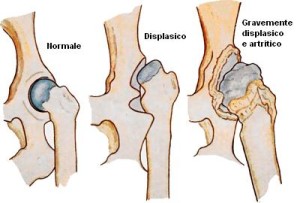 displasia-anca